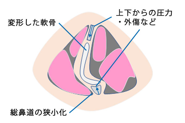 鼻中隔湾曲症の日帰り 短期入院手術なら横浜市の石井耳鼻咽喉科診療所