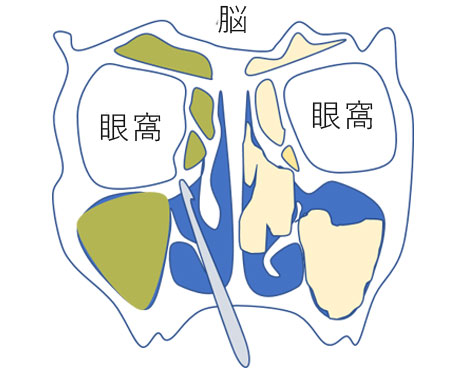 副鼻腔炎 蓄膿症 の手術なら横浜市の石井耳鼻咽喉科診療所へ