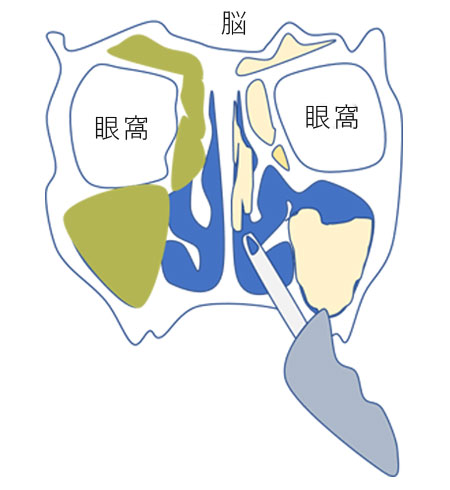 副鼻腔炎 蓄膿症 の手術なら横浜市の石井耳鼻咽喉科診療所へ