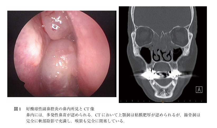 好酸球性副鼻腔炎のCT画像