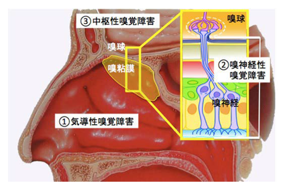 嗅覚障害の種類