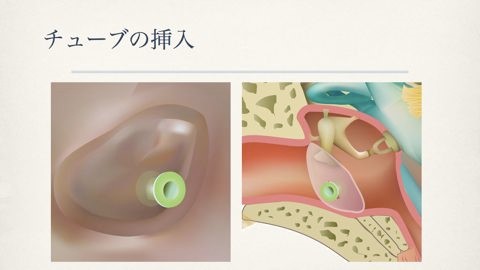 滲出性中耳炎鼓膜チューブ